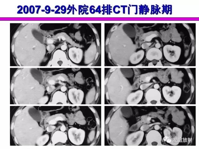 【PPT】胰腺神经内分泌肿瘤(pNet)的CT、MRI检查与诊断