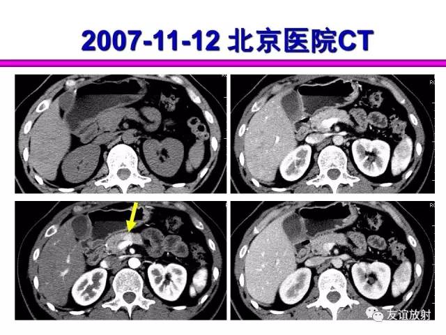 【PPT】胰腺神经内分泌肿瘤(pNet)的CT、MRI检查与诊断
