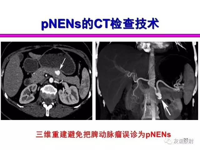 【PPT】胰腺神经内分泌肿瘤(pNet)的CT、MRI检查与诊断