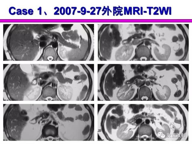【PPT】胰腺神经内分泌肿瘤(pNet)的CT、MRI检查与诊断