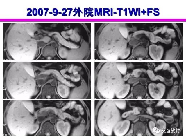 【PPT】胰腺神经内分泌肿瘤(pNet)的CT、MRI检查与诊断
