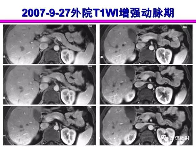 【PPT】胰腺神经内分泌肿瘤(pNet)的CT、MRI检查与诊断