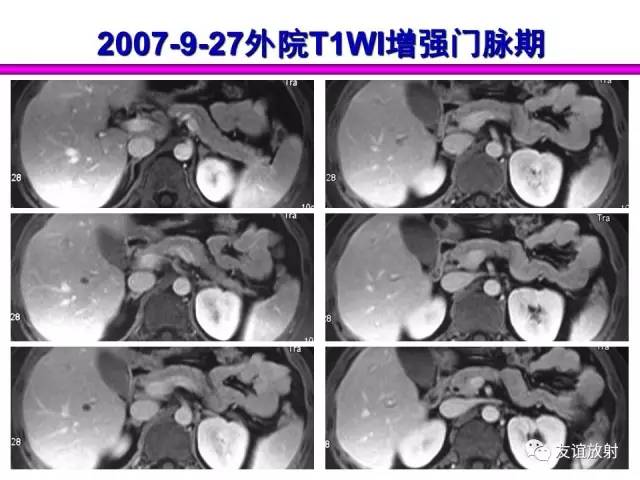 【PPT】胰腺神经内分泌肿瘤(pNet)的CT、MRI检查与诊断