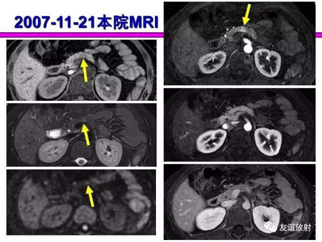 【PPT】胰腺神经内分泌肿瘤(pNet)的CT、MRI检查与诊断