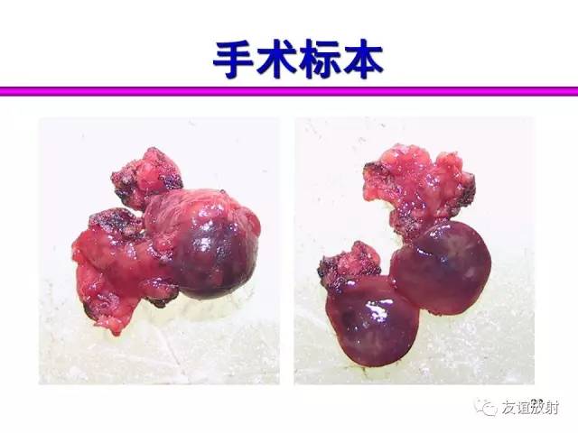 【PPT】胰腺神经内分泌肿瘤(pNet)的CT、MRI检查与诊断