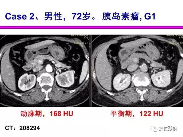 【PPT】胰腺神经内分泌肿瘤(pNet)的CT、MRI检查与诊断