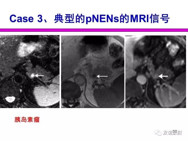 【PPT】胰腺神经内分泌肿瘤(pNet)的CT、MRI检查与诊断