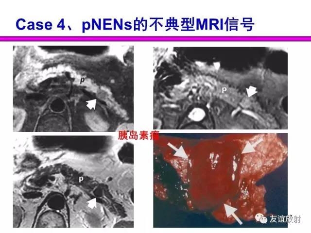 【PPT】胰腺神经内分泌肿瘤(pNet)的CT、MRI检查与诊断