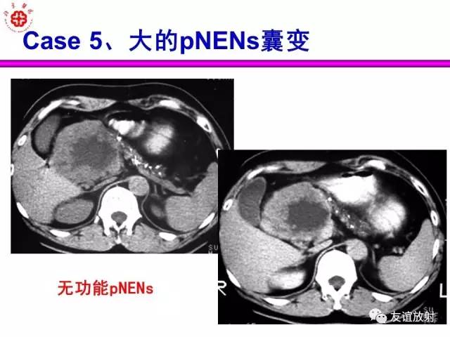 【PPT】胰腺神经内分泌肿瘤(pNet)的CT、MRI检查与诊断