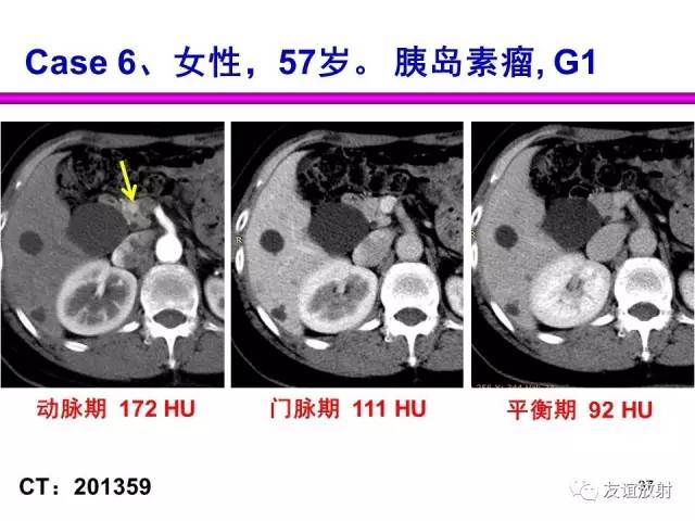 【PPT】胰腺神经内分泌肿瘤(pNet)的CT、MRI检查与诊断