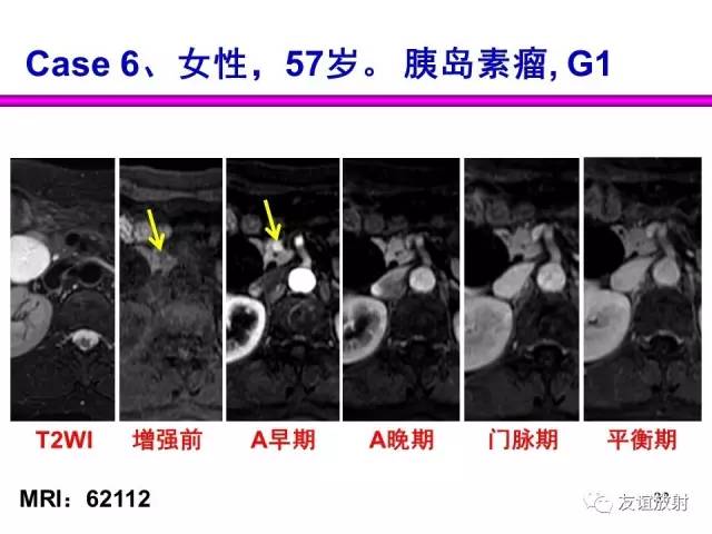 【PPT】胰腺神经内分泌肿瘤(pNet)的CT、MRI检查与诊断