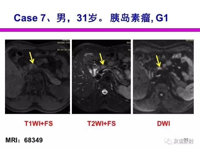 【PPT】胰腺神经内分泌肿瘤(pNet)的CT、MRI检查与诊断