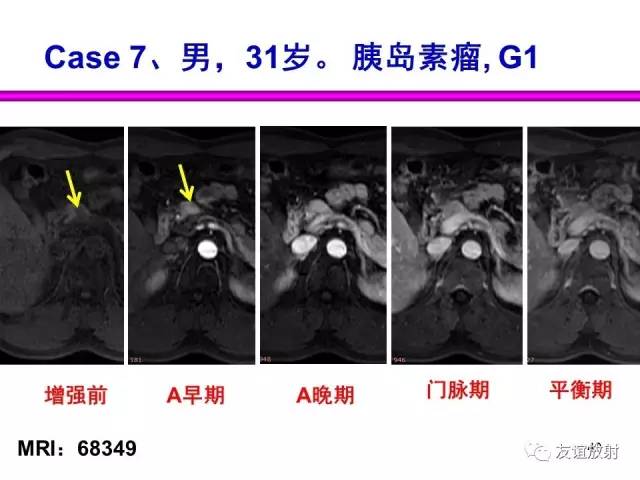 【PPT】胰腺神经内分泌肿瘤(pNet)的CT、MRI检查与诊断