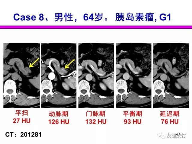 【PPT】胰腺神经内分泌肿瘤(pNet)的CT、MRI检查与诊断