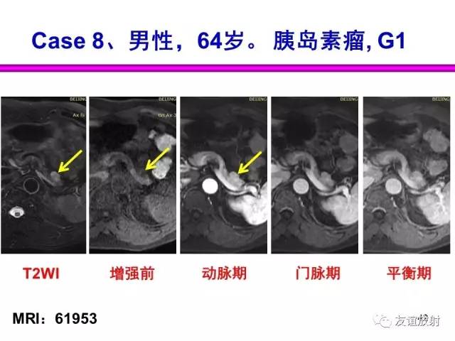 【PPT】胰腺神经内分泌肿瘤(pNet)的CT、MRI检查与诊断