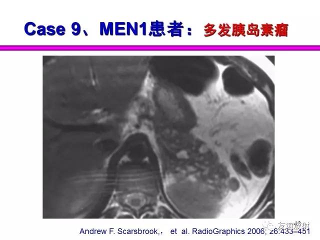 【PPT】胰腺神经内分泌肿瘤(pNet)的CT、MRI检查与诊断