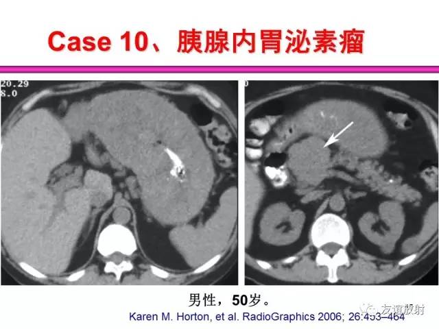 【PPT】胰腺神经内分泌肿瘤(pNet)的CT、MRI检查与诊断