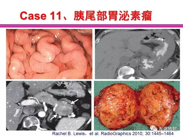 【PPT】胰腺神经内分泌肿瘤(pNet)的CT、MRI检查与诊断