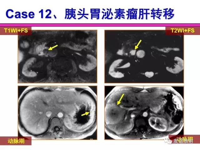 【PPT】胰腺神经内分泌肿瘤(pNet)的CT、MRI检查与诊断
