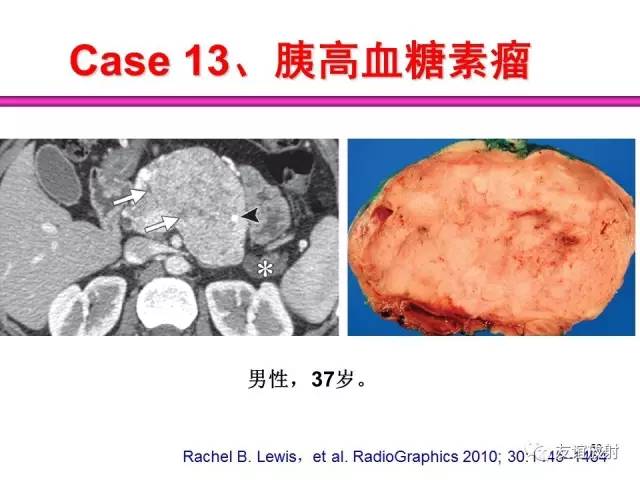 【PPT】胰腺神经内分泌肿瘤(pNet)的CT、MRI检查与诊断