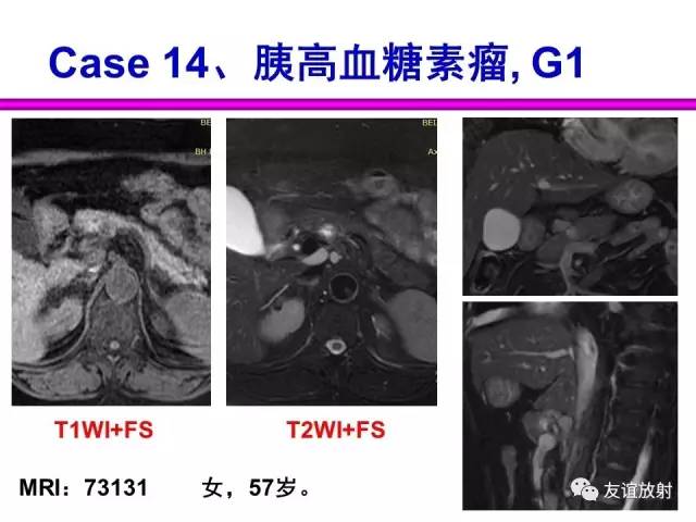 【PPT】胰腺神经内分泌肿瘤(pNet)的CT、MRI检查与诊断