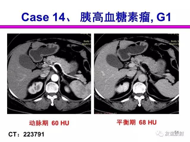 【PPT】胰腺神经内分泌肿瘤(pNet)的CT、MRI检查与诊断