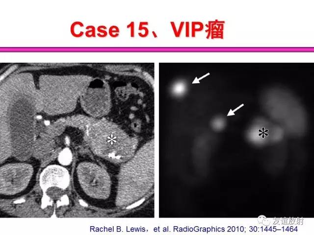 【PPT】胰腺神经内分泌肿瘤(pNet)的CT、MRI检查与诊断