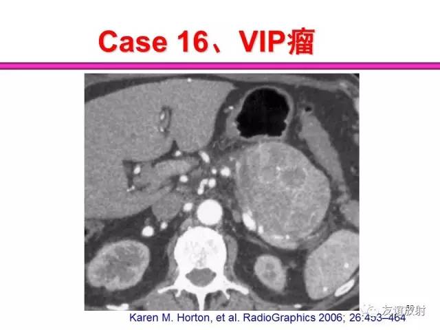 【PPT】胰腺神经内分泌肿瘤(pNet)的CT、MRI检查与诊断