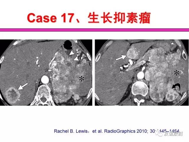 【PPT】胰腺神经内分泌肿瘤(pNet)的CT、MRI检查与诊断