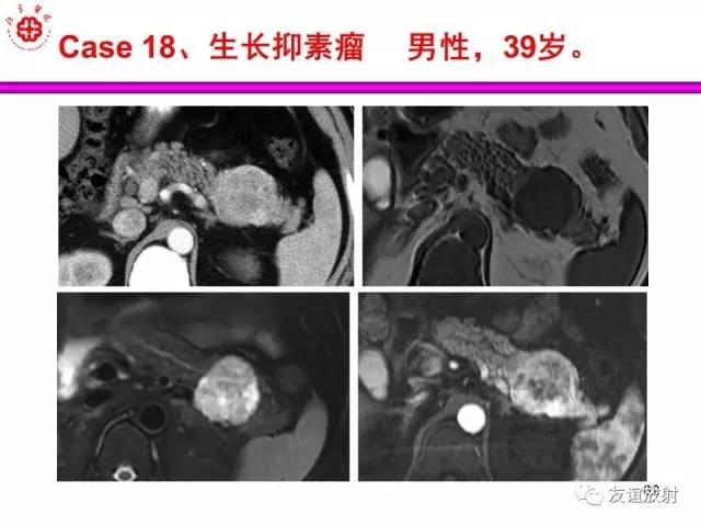 【PPT】胰腺神经内分泌肿瘤(pNet)的CT、MRI检查与诊断
