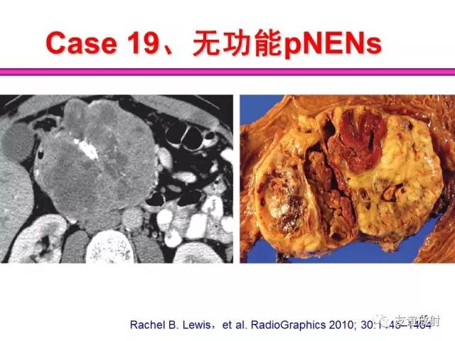 【PPT】胰腺神经内分泌肿瘤(pNet)的CT、MRI检查与诊断