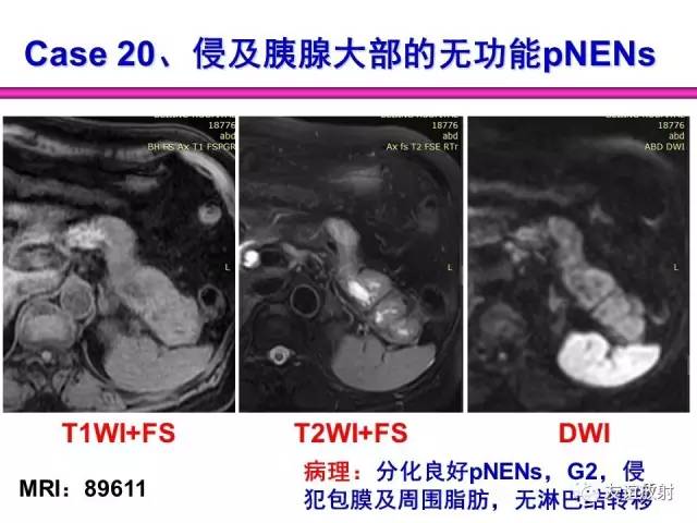 【PPT】胰腺神经内分泌肿瘤(pNet)的CT、MRI检查与诊断