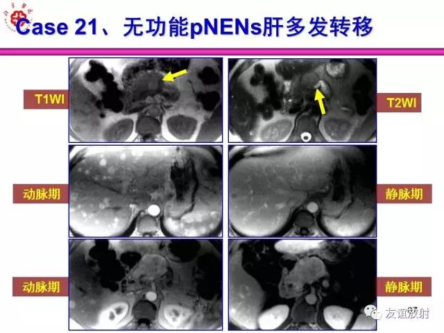 【PPT】胰腺神经内分泌肿瘤(pNet)的CT、MRI检查与诊断