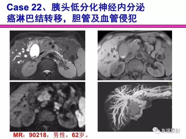【PPT】胰腺神经内分泌肿瘤(pNet)的CT、MRI检查与诊断