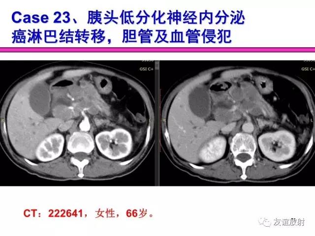 【PPT】胰腺神经内分泌肿瘤(pNet)的CT、MRI检查与诊断