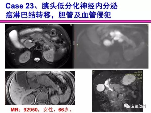 【PPT】胰腺神经内分泌肿瘤(pNet)的CT、MRI检查与诊断
