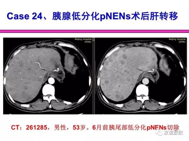 【PPT】胰腺神经内分泌肿瘤(pNet)的CT、MRI检查与诊断