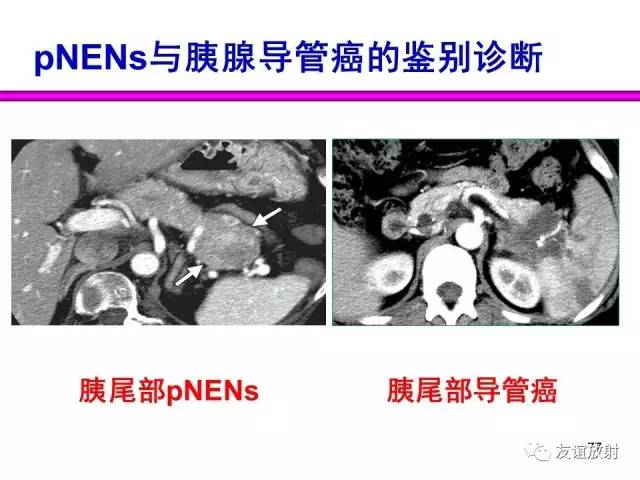 【PPT】胰腺神经内分泌肿瘤(pNet)的CT、MRI检查与诊断