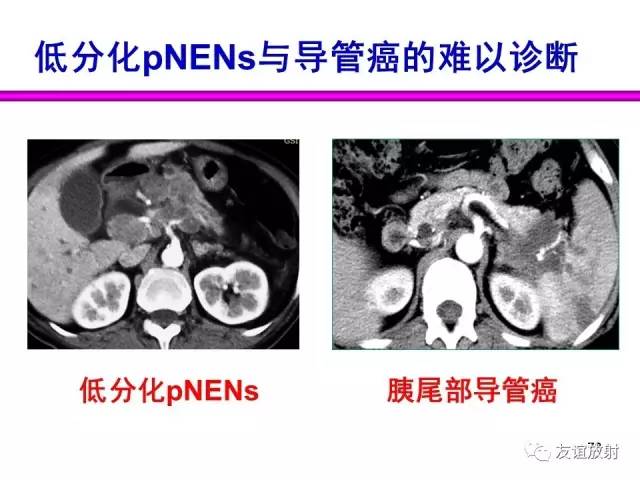 【PPT】胰腺神经内分泌肿瘤(pNet)的CT、MRI检查与诊断