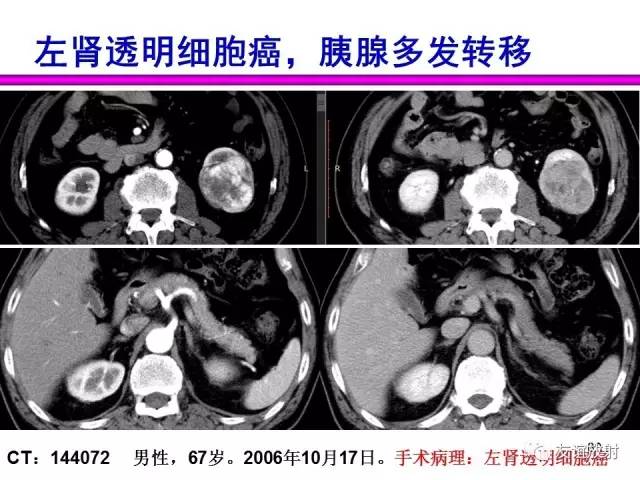 【PPT】胰腺神经内分泌肿瘤(pNet)的CT、MRI检查与诊断