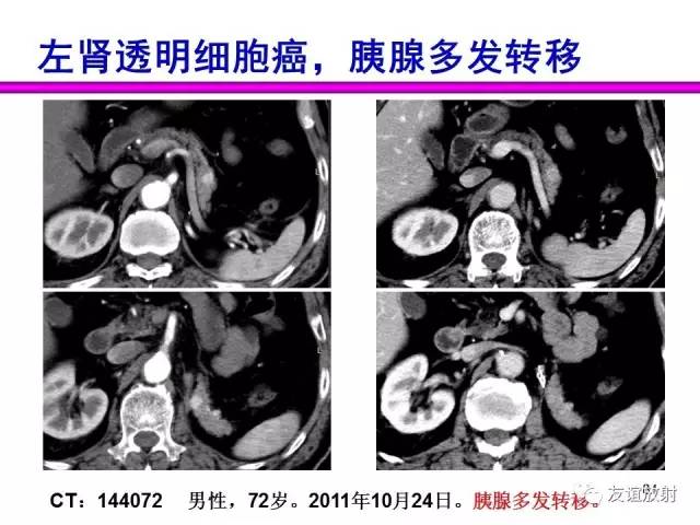 【PPT】胰腺神经内分泌肿瘤(pNet)的CT、MRI检查与诊断