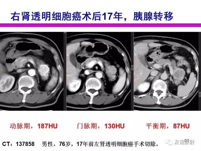 【PPT】胰腺神经内分泌肿瘤(pNet)的CT、MRI检查与诊断