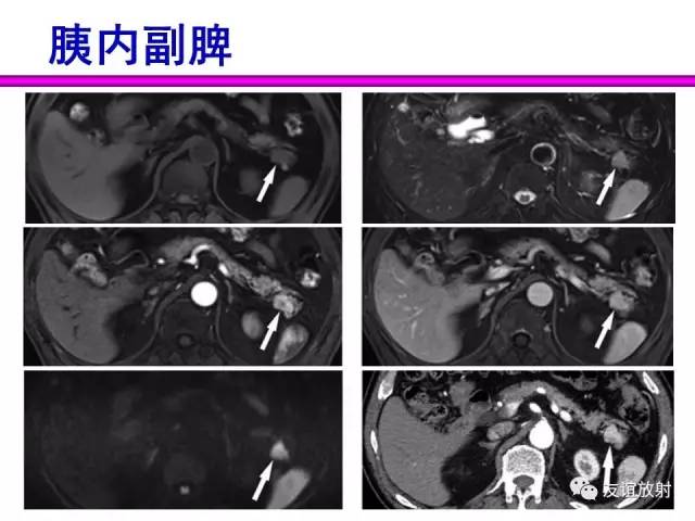 【PPT】胰腺神经内分泌肿瘤(pNet)的CT、MRI检查与诊断