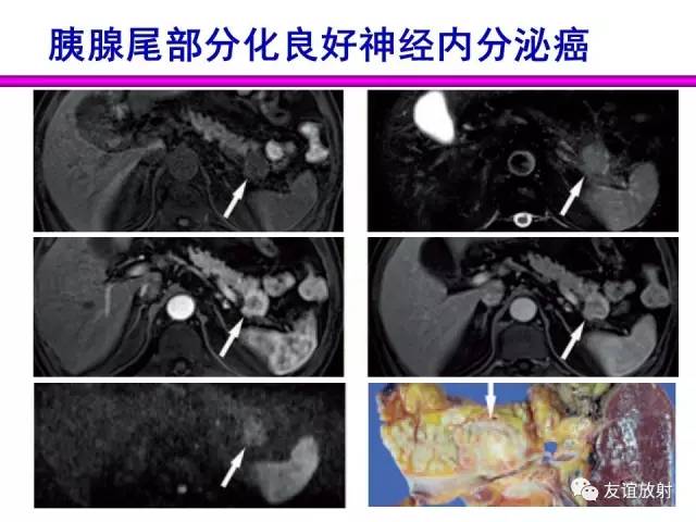 【PPT】胰腺神经内分泌肿瘤(pNet)的CT、MRI检查与诊断