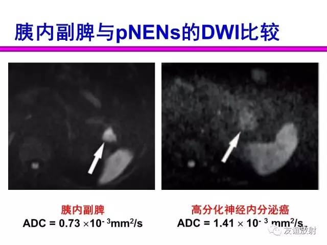 【PPT】胰腺神经内分泌肿瘤(pNet)的CT、MRI检查与诊断
