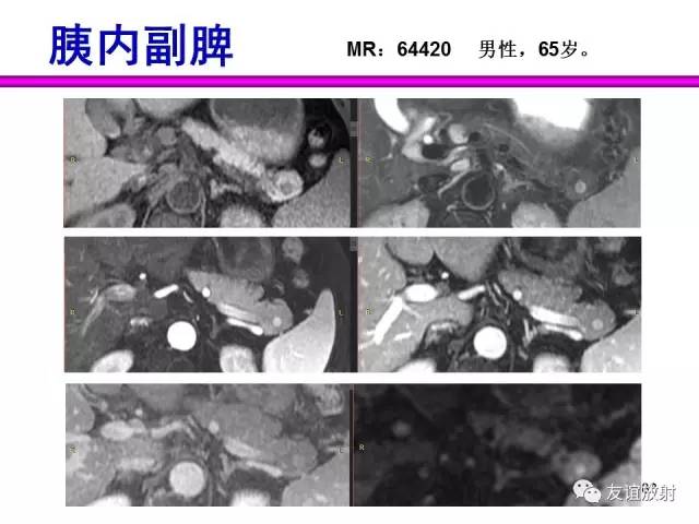 【PPT】胰腺神经内分泌肿瘤(pNet)的CT、MRI检查与诊断