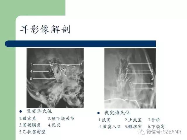 【PPT】外中耳解剖及变异畸形CT表现
