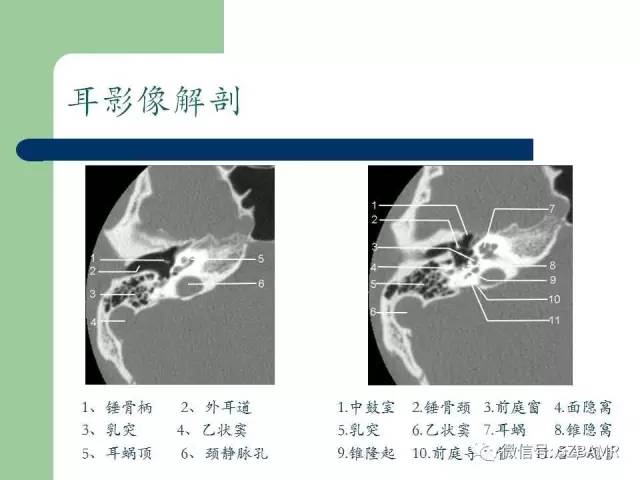 【PPT】外中耳解剖及变异畸形CT表现