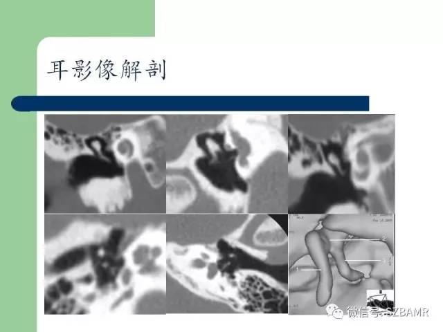 【PPT】外中耳解剖及变异畸形CT表现