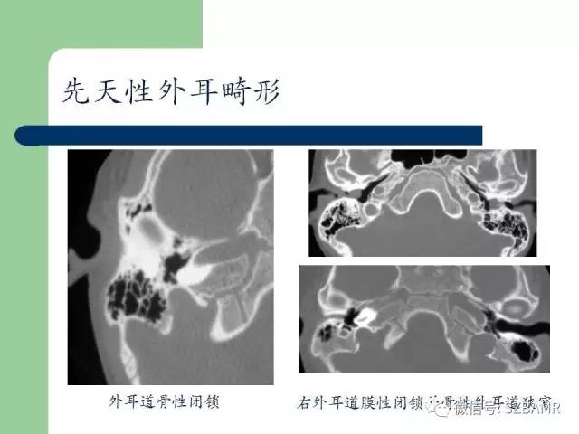 【PPT】外中耳解剖及变异畸形CT表现